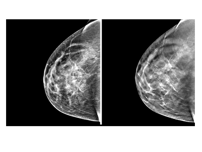 Mammography QA Test Tools – Southern Scientific